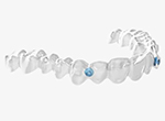 マウスピース型カスタムメイド矯正歯科装置（エンジェルアライナー）